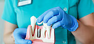 Best Dental Implants Services in Gurgaon - The Dental Roots