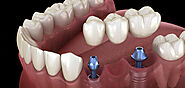 Dental Implant Costs in India: The Dental Roots Pricing