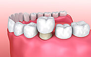 Affordable Tooth Bridge Services in Auckland