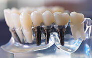 Don't Miss Out on Affordable Dental Implants in Auckland