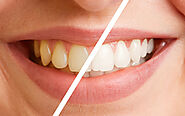 Book Now for Teeth Scaling & Polishing Treatment in Auckland