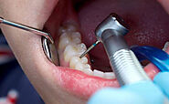 Root Canal Treatment in Auckland at Affordable Prices