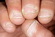 Gnawed Nails