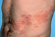 What Does the Shingles Rash Look Like?