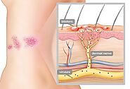 What Causes Shingles?