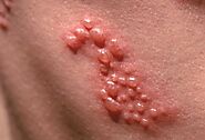 Diagnosing Shingles