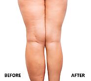 Body Sculpting in Richmond | Non-Surgical Body Contouring in Richmond