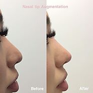 Lip Augmentation in Richmond | Richmond Cosmetic & Laser