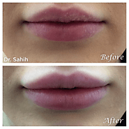 Find Best Non-Surgical Lips Augmentation in Richmond