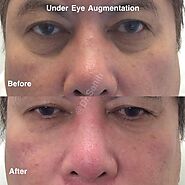 Non-Surgical Nose Augmentation Richmond | Expert Dermal Filler Specialist