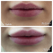 Why Choose Non-Surgical Lip Augmentation in Richmond