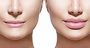 Non-Surgical Nose and Lips Augmentation in Richmond