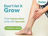 Ayurvedic Treatment Varicose Veins | Varicose Veins in Ayurveda by Sushain