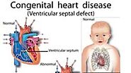 GAPS IN PROVIDING CARE TO CHILDREN WITH CONGENITAL HEART DEFECTS | By Soumya Bajaj | Tealfeed