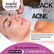 Get the natural looking glow from Black peel - Twacha Aesthetic Clinic