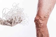 Can Veiny Legs Be a Sign of Varicose Veins?