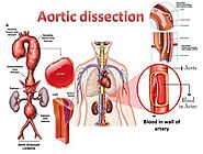 Aortic Dissection: What You Need to Know