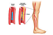 What are the Causes and Symptoms of Peripheral Vascular Disease?