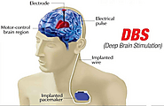 Life After Deep Brain Stimulation: Risk Factors & Complication