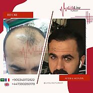 What is the cost of Fut hair Transplant Turkey?