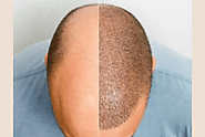 Hair thinning? No more grinning, a hair transplant is a winning beginning