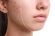 What is Acne: Understanding the Root Causes and Treatment Options – Articles – Wikiful