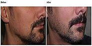 Fue Hair Transplant in Kuwait - Classifieds