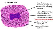 http://ilovepathology.com/actinomycosis/