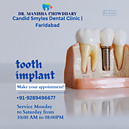 Dental Implants Treatment: Importance, Procedure, And Cost Explained