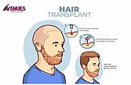 Body to Scalp: Emerging Trends in Body Hair Transplantation