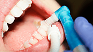 5 Vital Advantages of Dental Cleanings
