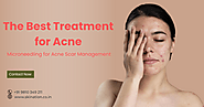 Microneedling for Acne Scar Management ~ Skination Clinic