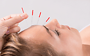 Cosmetic Acupuncture – Inner Beauty Acuclinic