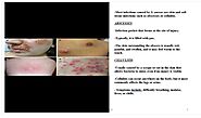 Signs and symptoms of infection.