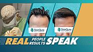 Hair Transplant Treatment in Delhi by the expert Dr. Jangid