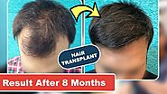 Hair Transplant Discussion With Patient