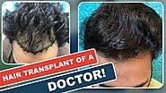 Before/After Hair Transplant Results Of Doctor