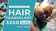 FUE Hair Transplant Surgery in India