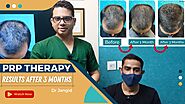 Hair Transplant by Experts in Delhi