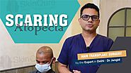 Hair Transplant Planning for Scaring Alopecia