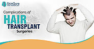 Success Rate Of Hair Transplant Surgery