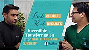 Incredible Transformation after Hair Transplant Surgery