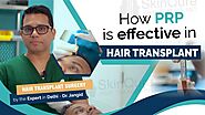 How PRP is Effective in Hair Transplant