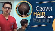 Crown Hair Transplant Planning by Dr. Jangid