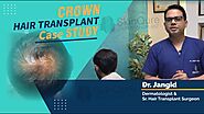 Crown Hair Transplant Case-Study