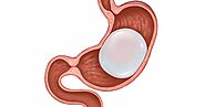 Is Gastric Balloon Painful?