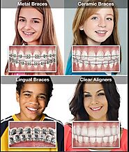 Can Insurance Cover Braces ?