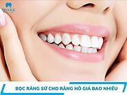 Bọc răng sứ cho răng hô giá bao nhiêu, bọc có hết hô không?