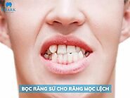 Có nên bọc răng sứ cho răng mọc lệch và thực hiện thế nào?