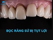 Bọc răng sứ bị tụt lợi - Nguyên nhân và cách khắc phục